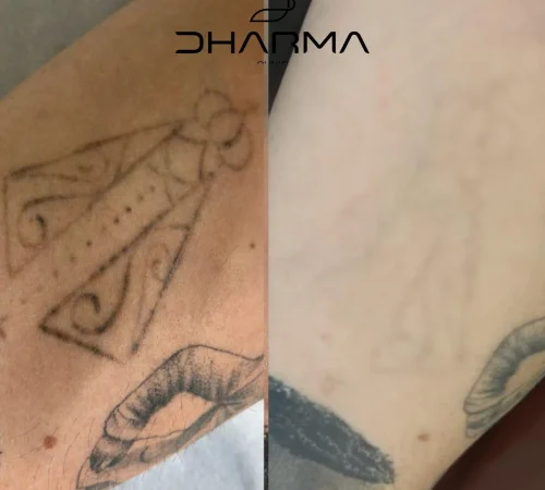Paciente de antes e depois de remoção de tatuagem a laser em sao paulo