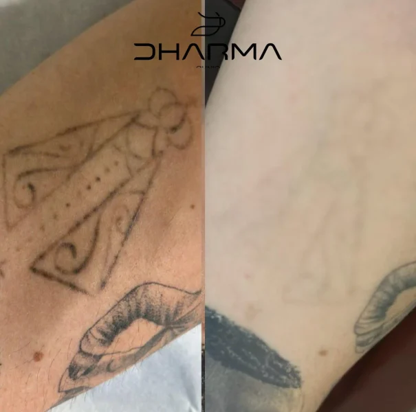 Paciente de antes e depois de remoção de tatuagem a laser em sao paulo