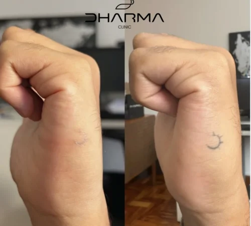 Paciente de antes e depois de remoção de tatuagem a laser em sao paulo