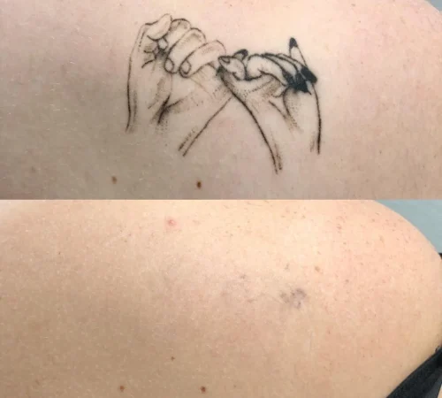 Paciente de antes e depois de remoção de tatuagem a laser em sao paulo