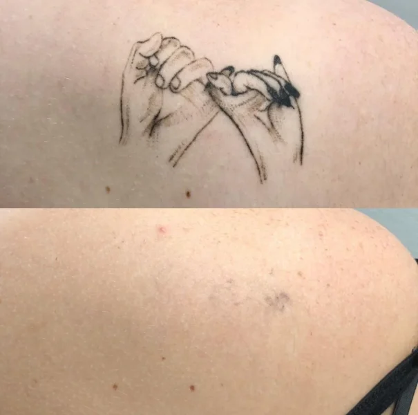 Paciente de antes e depois de remoção de tatuagem a laser em sao paulo