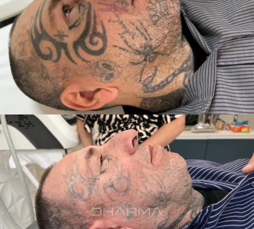 Paciente de antes e depois de remoção de tatuagem a laser em sao paulo