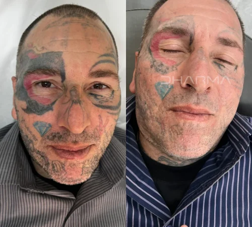 Paciente de antes e depois de remoção de tatuagem a laser em sao paulo