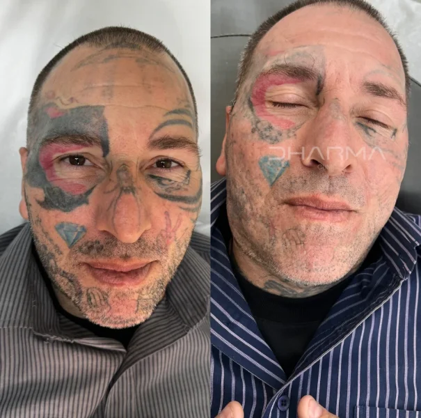 Paciente de antes e depois de remoção de tatuagem a laser em sao paulo
