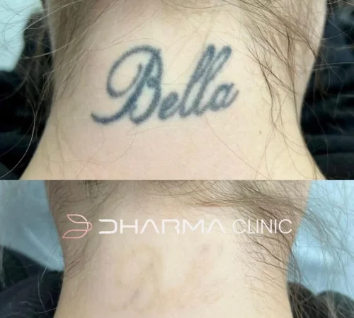 Paciente de antes e depois de remoção de tatuagem a laser em sao paulo