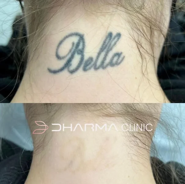 Paciente de antes e depois de remoção de tatuagem a laser em sao paulo