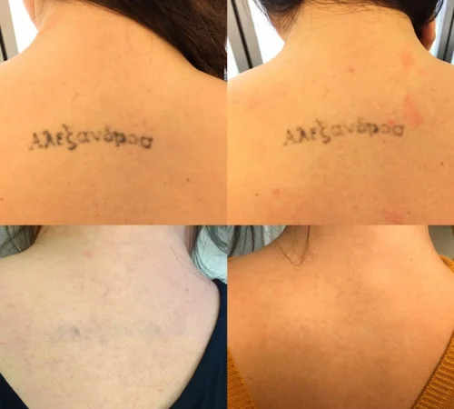 Paciente de antes e depois de remoção de tatuagem a laser em sao paulo