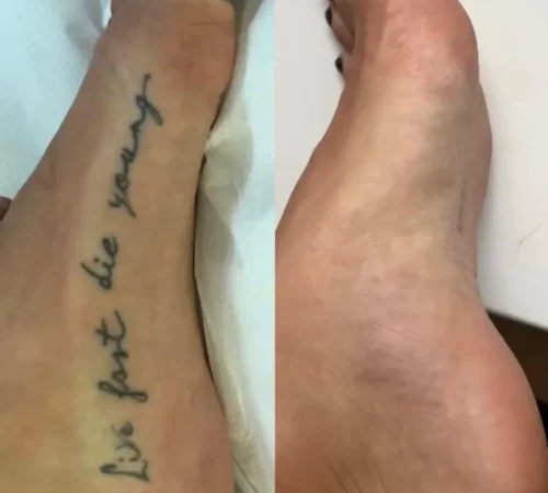 Paciente de antes e depois de remoção de tatuagem a laser em sao paulo