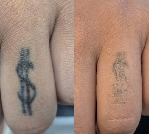 Tatuagem_desaparecendo_202605131302