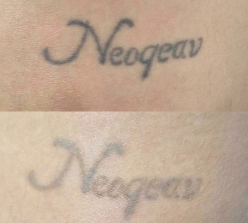 Tatuagem_desaparecendo_202605131302_2