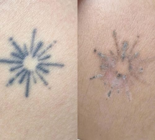 Tatuagem_remoção_imagem_direita_202605131302